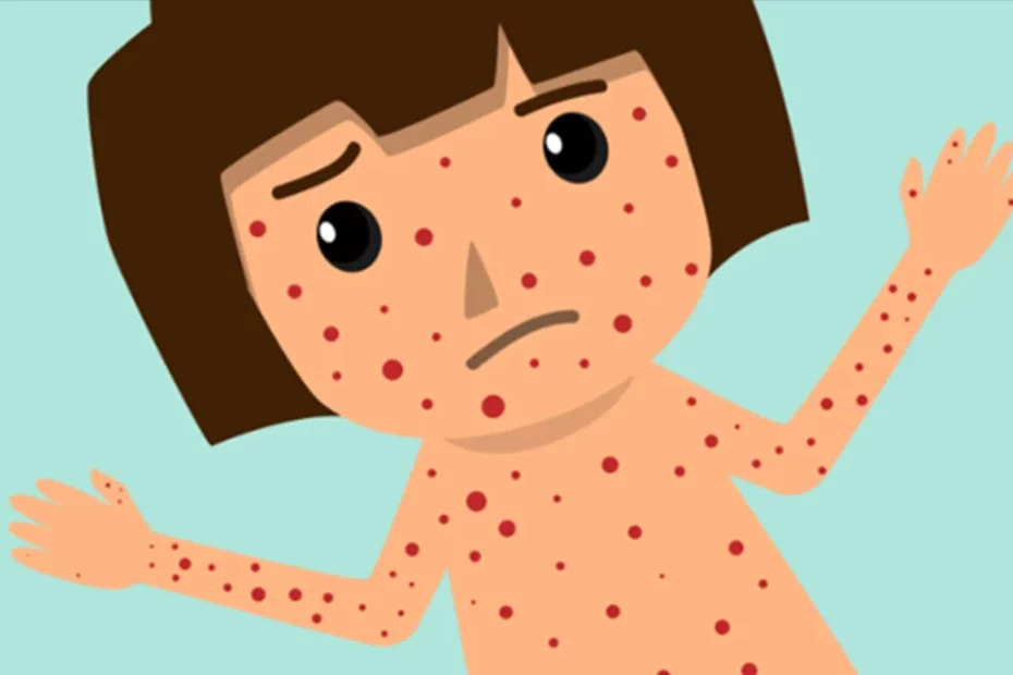 Буллёзный эпидермолиз